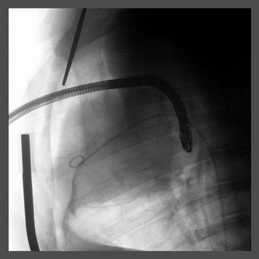 procedure heart